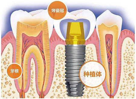 种植牙价格差距那么大，究竟差在哪里？
