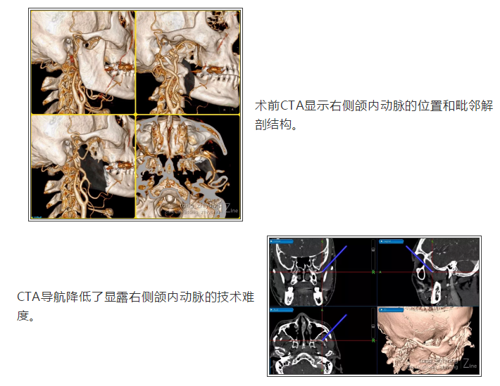 佟志勇:颌内动脉搭桥—后循环血管重建新选项