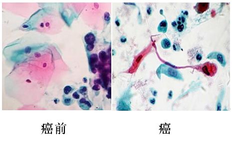 宫颈细胞学检查,是一种非常成熟,可靠,便捷的方法.