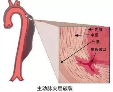 ptca手术全称是什么 心脏支架手术后的药费医保报销吗