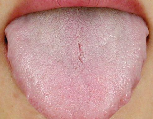 (2)舌苔铺满舌头,说明体内湿重 一般来说,正常的舌苔应该是把舌质露