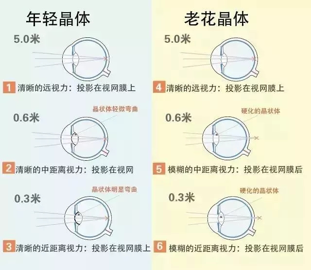 躲不掉的老花眼和白内障这种方法让您同时摆脱两种烦恼