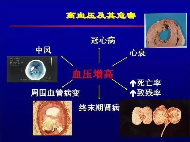 高血压病危害在于并发症.