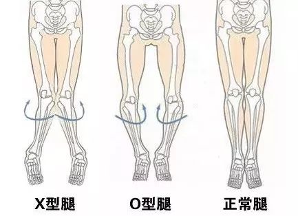 如何拯救你的x型腿?