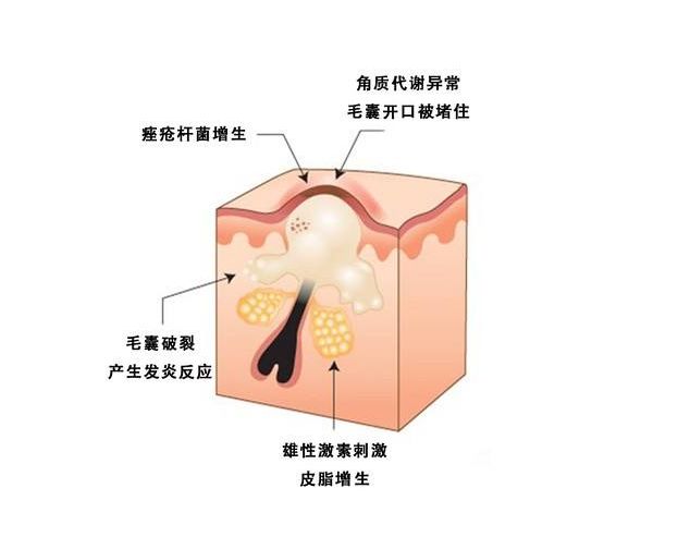 痘痘总是反复长怎么办