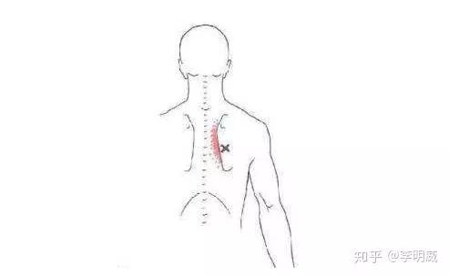 今天这篇文章所说的上背部不是整体的后背发僵发紧,它有具体的位置,在