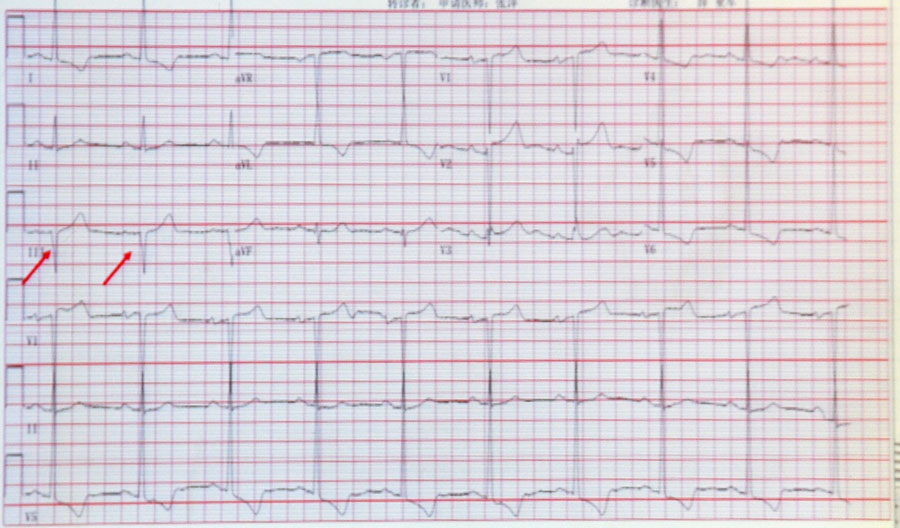 肥厚型心肌病心电图的特征与分析