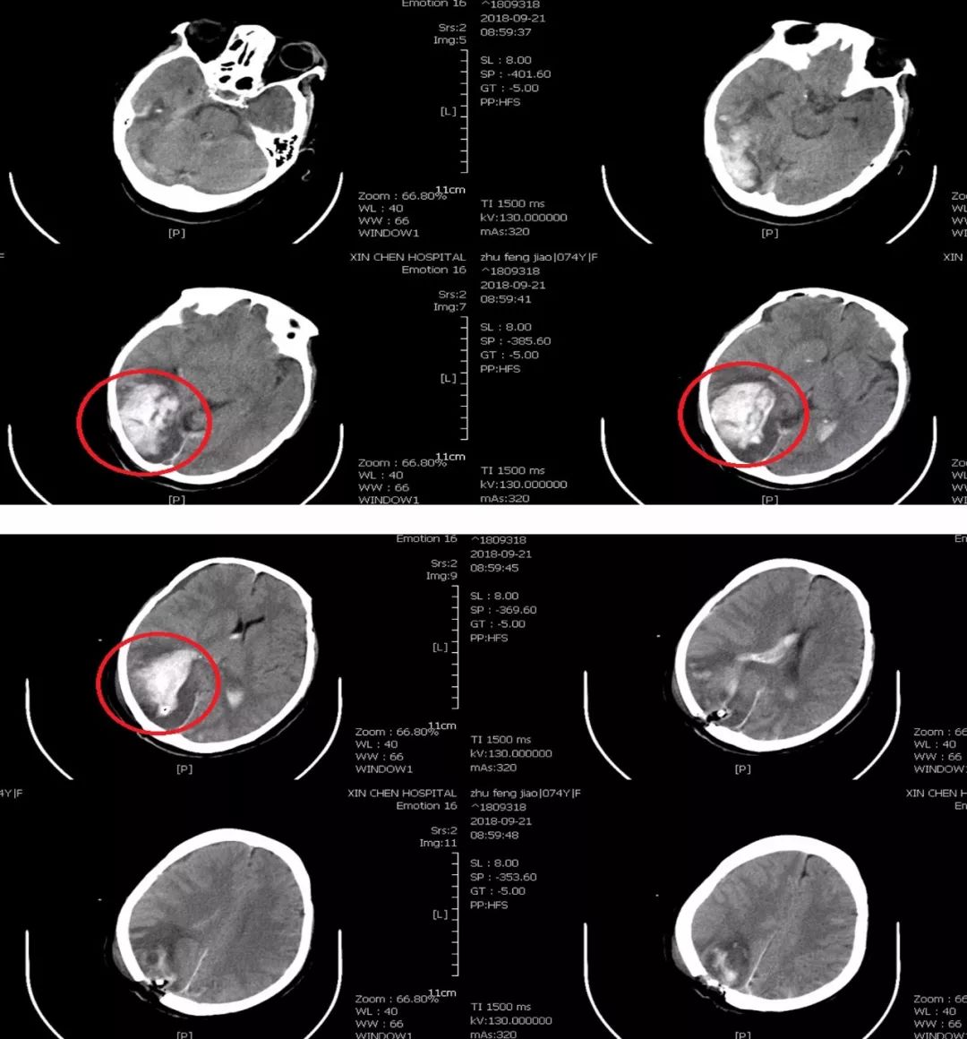 血小板计数降低至68*109/l,复查头颅ct显示颅内有新的出血发生