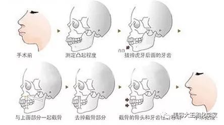 如何辨别自己是"齿性"还是"骨性"?