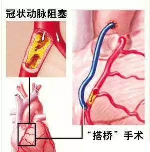 32个冠脉搭桥手术疑问,最详尽的解答!