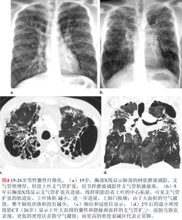 囊性纤维化的肺受损后其分泌物的清除受损主要影响上肺,因为增加的