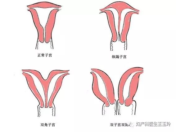 不孕,流产,早产,你有想过自己的子宫异于常人吗?