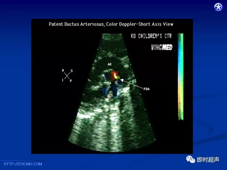 小儿先天性心脏病超声心动图检查_版权