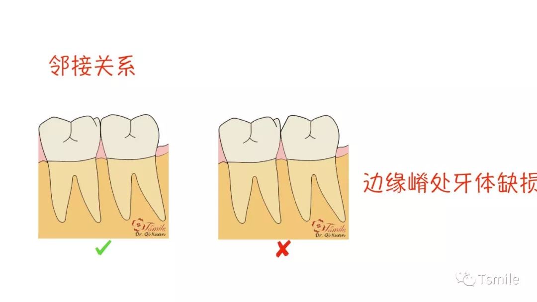 三,相邻牙齿颊舌轴面协调关系异常导致的食物嵌 塞