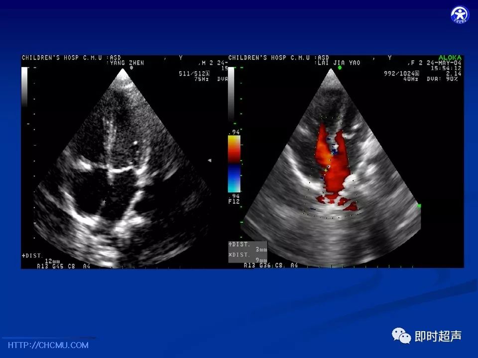 小儿先天性心脏病超声心动图检查