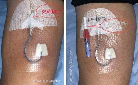 记录:在护理记录单及 picc 维护记录本上登记. 5.