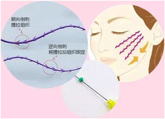 收藏线雕知识以后除皱逆龄用的上