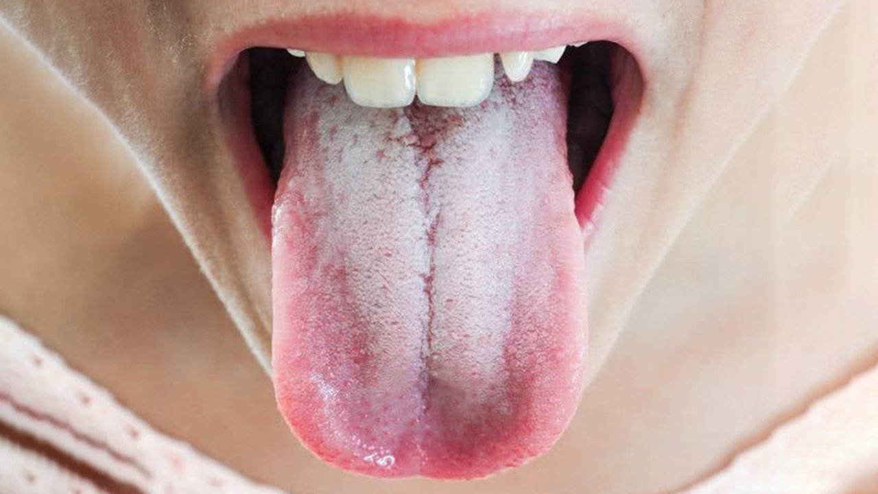 正常人的舌苔,是均匀的铺在舌面上,薄薄的透出红色.