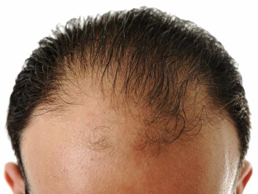 【男人不可不知的10大秃头原因，看看你占了几个，再不改掉就真秃了】 