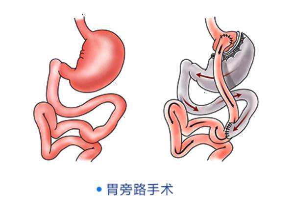 胃束带折叠手术对比胃旁路手术有什么不同