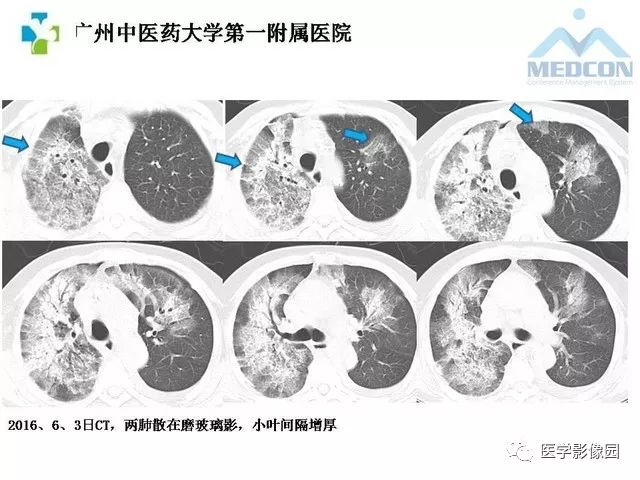 病毒性肺炎影像诊断与鉴别诊断 | 影像天地