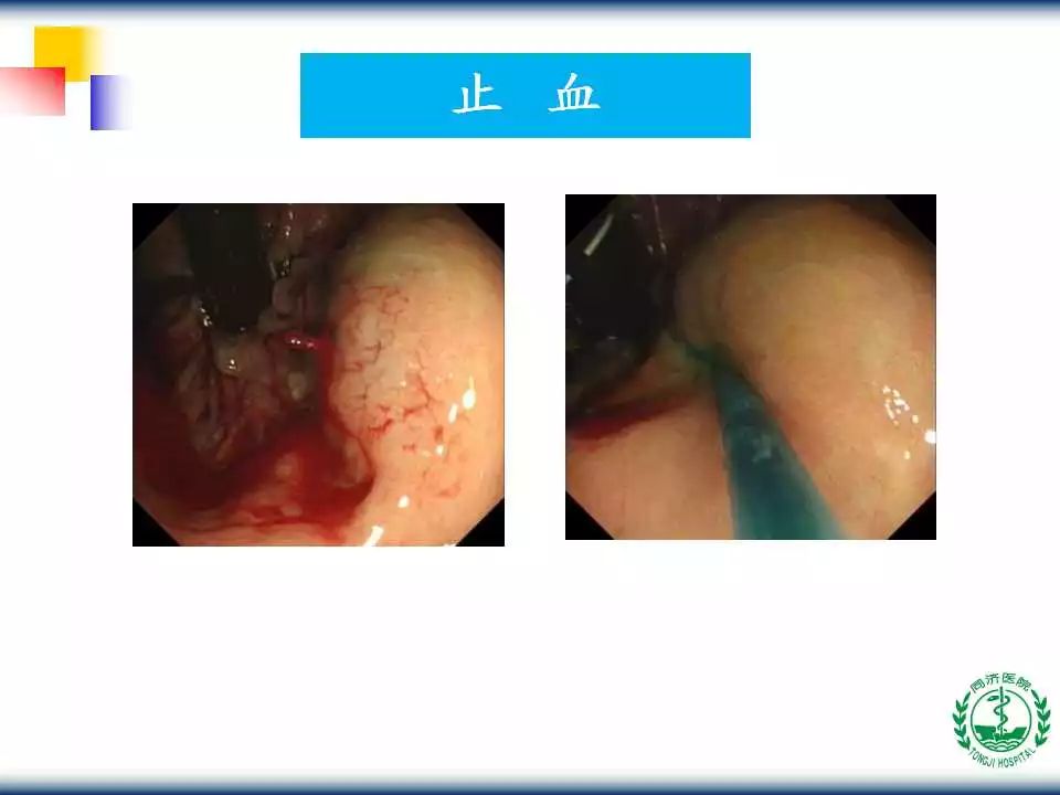 教学ppt | 内镜下内痔硬化治疗术(内含视频,推荐收藏!