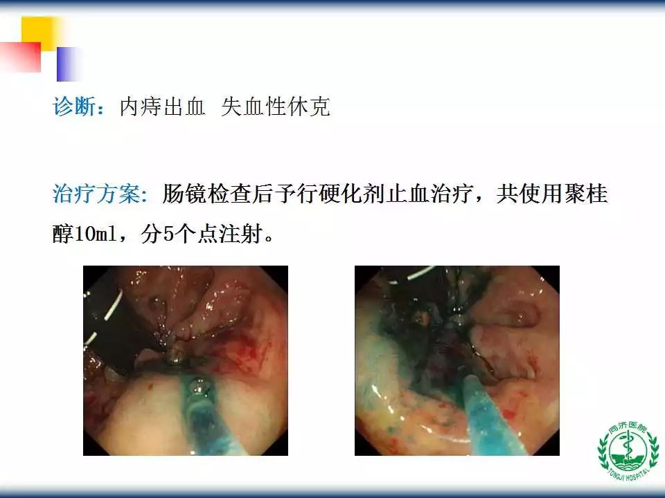 教学ppt | 内镜下内痔硬化治疗术(内含视频,推荐收藏!