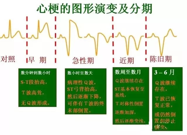 这样教你看心电图,没有理由看不懂 !