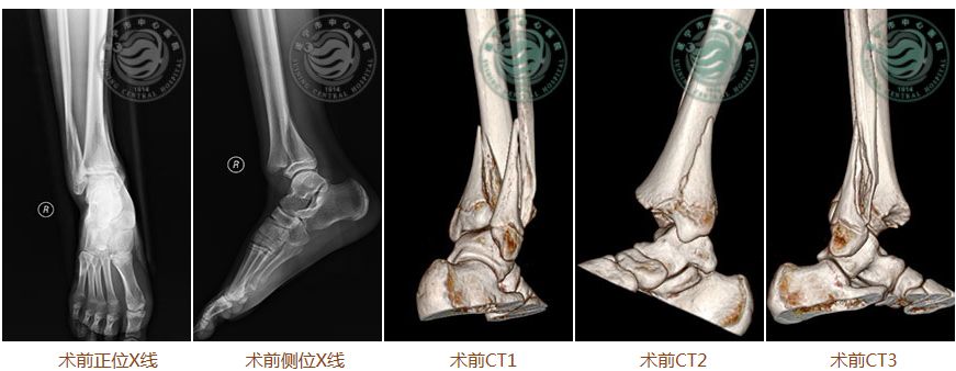 骨折 期間 足 入院 骨折の治療期間