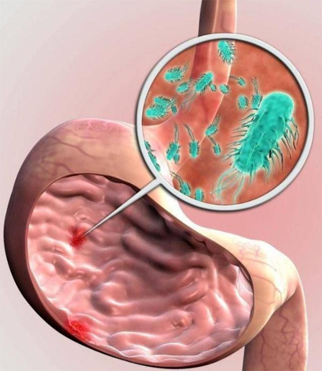提醒:感染上幽门螺杆菌,可能会有这5个症状,大多数人都忽略了