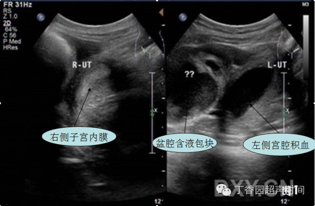 超声所见:盆腔可见双子宫,双宫颈,双阴道伴左侧阴道闭锁,积血,合并左