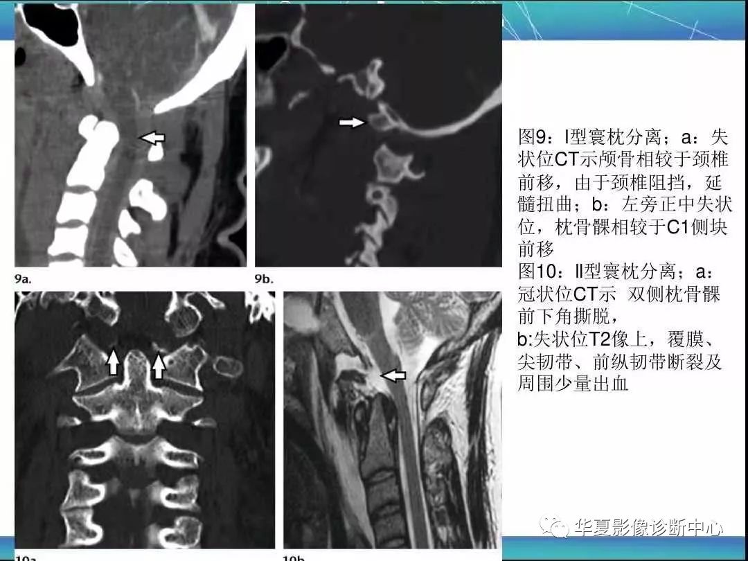 寰枕及寰枢关节外伤的影像学表现