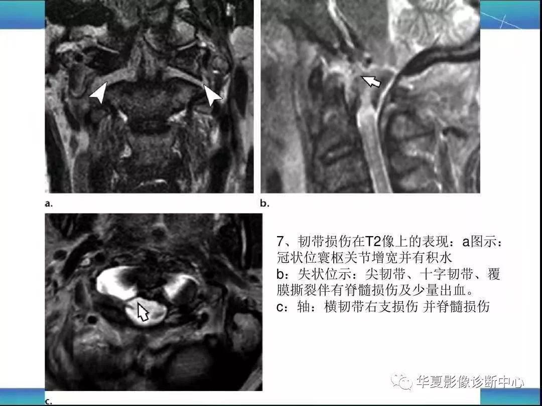 寰枕及寰枢关节外伤的影像学表现