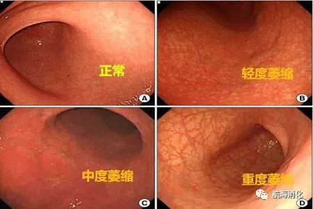 胃镜检查诊断的慢性胃炎病例中17%是萎缩性胃炎.