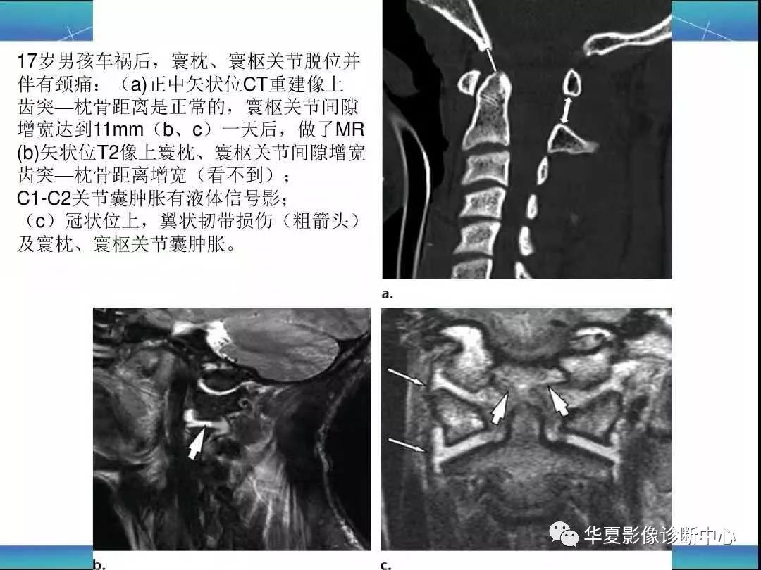 寰枕及寰枢关节外伤的影像学表现