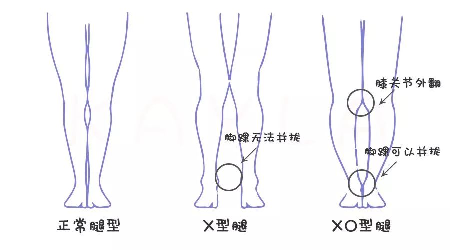 x和xo型腿的区别就是,x型腿脚踝是无法并拢的.