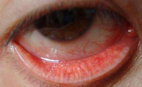 【沙眼】沙眼的症状_沙眼的治疗