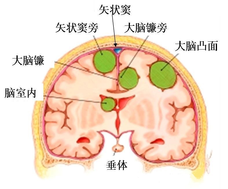 脑膜瘤好发于颅内的哪个部位?