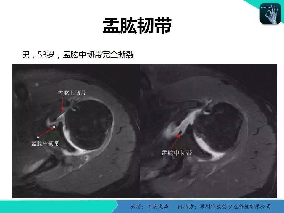 精品课件| 肩关节病变mri解剖和诊断