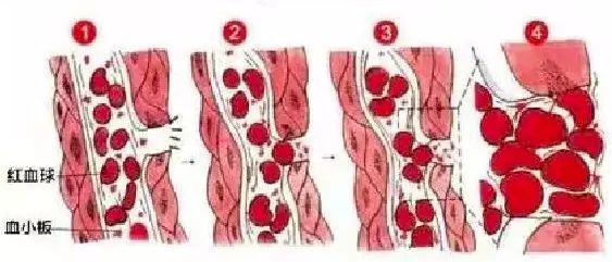 伤口怎么愈合,这是血小板的神奇作用