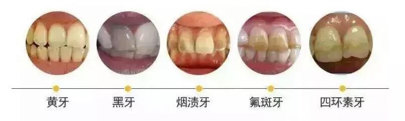 ④黄黑牙/色素牙