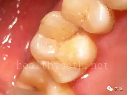 牙隐裂,牙齿表面有肉眼看不到的裂纹,细菌通过其进入牙髓,容易出现