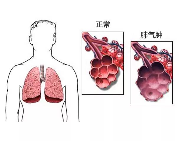 肺气肿要怎么治疗?