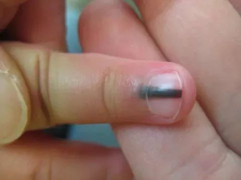 注意:黑色素瘤指甲的特点是黑色会在指甲的边缘处逐渐扩散.
