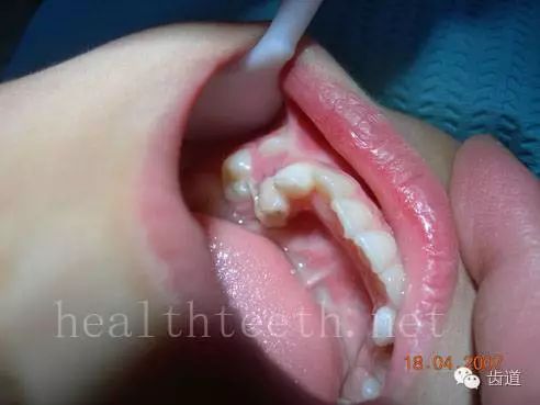 牙根穿出牙龈对上唇粘膜造成刺激四,孩子的牙齿问题舌息肉,该患者同时