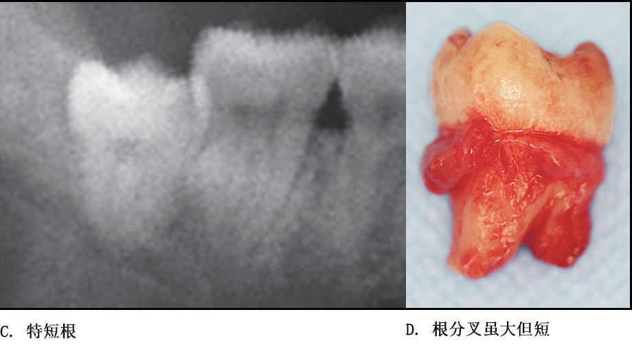 单根牙,根分叉不大者,合并根,融合根,特短根,锥形根阻力较小.