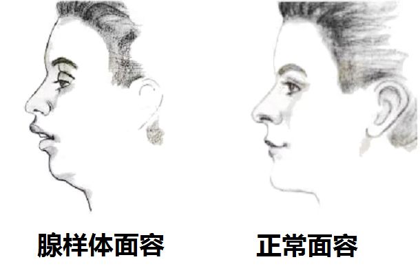 腺样体肥大使孩子倾向于用口替代鼻子呼吸,长此以往,容易造成面部的