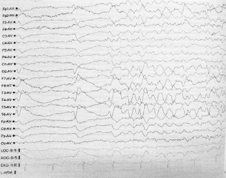 患者脑电图检查结果示右侧前额,额,中颞及后颞单发尖慢波