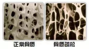 骨质疏松是指骨骼 在显微镜下呈蜂窝状 与正常健康骨骼相比 骨质孔隙