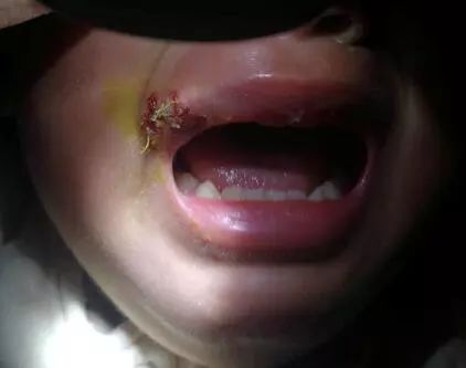 贵阳2岁小孩在幼儿园受伤,嘴角缝8针!正好是"监控死角